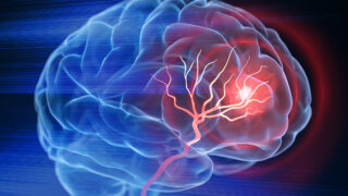 X- Ray illustration of brain stroke - 3d Illustration