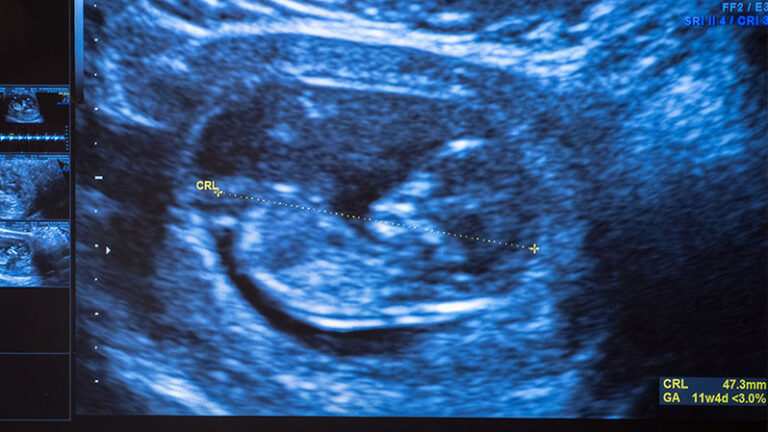 Ultrasound image