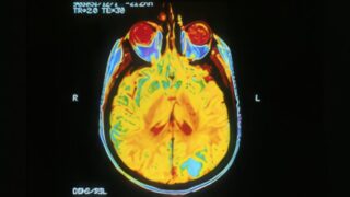 A brain scan with yellow highlights