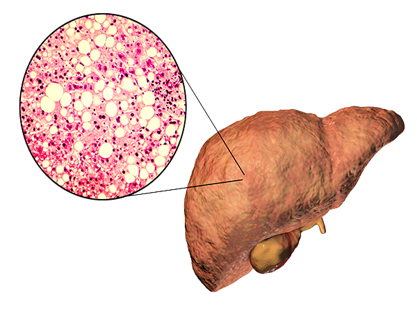 3D illustration of fatty liver and liver cells