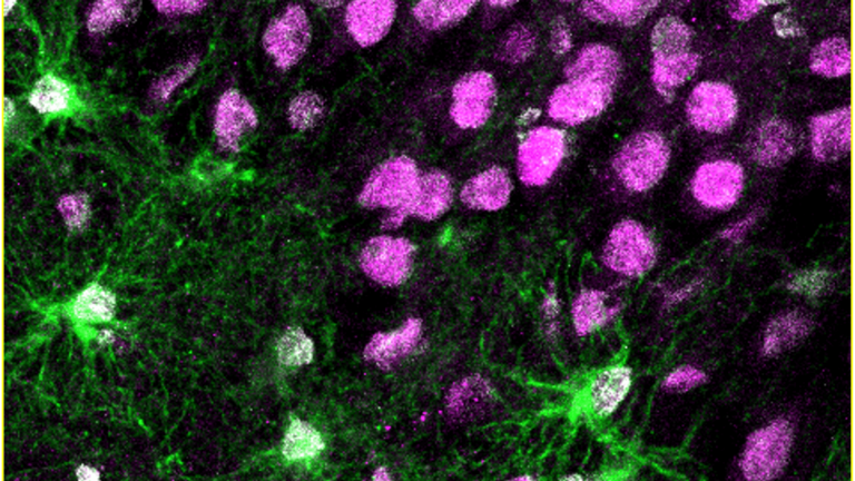 Newborn astroglia (green) in brain tissue from human epilepsy patients (Image by Aswathy Ammothumkandy/Bonaguidi Lab/USC Stem Cell)