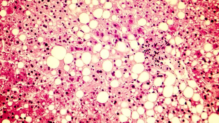Fatty liver, liver steatosis. Photomicrograph showing large vacuoles of triglyceride fat accumulated inside liver cells, it occurs in alcohol overuse, under action of toxins, in diabetes