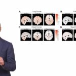 Brain Metastasis (BM) is when cancers spread to the brain from their primary sites. Gabriel Zada, MD, breaks down findings that show different cancers spread to predictably different areas of the brain, and why that is important to cancer research and treatment options.