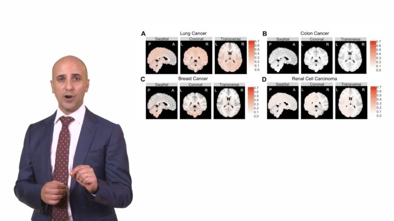 Brain Metastasis (BM) is when cancers spread to the brain from their primary sites. Gabriel Zada, MD, breaks down findings that show different cancers spread to predictably different areas of the brain, and why that is important to cancer research and treatment options.
