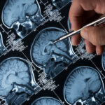MRI Brain Scan