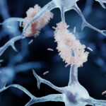 Image shows illustration of amyloid plaques in the brain.