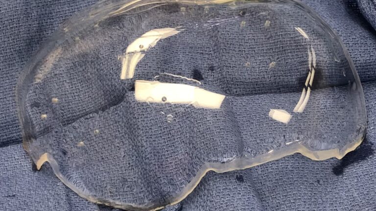 Clear experimental skull implant may enable functional ultrasound imaging of the brain for patients with serious head injuries. Photo/Todd Patterson