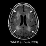 image shows a FLAIR MRI brain scan with white matter hyperintensities.