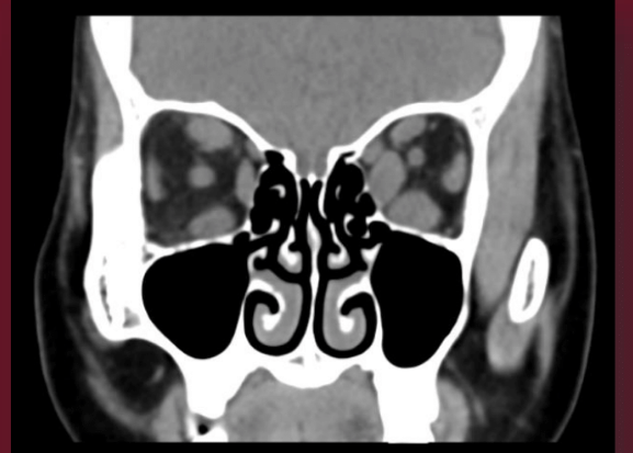 CT orbits showing the enlarged extraocular muscles causing exophthalmos (bulging eye) and double vision in a patient