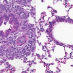 Research image on the left shows inflammation caused by activated immune cells in the lungs while image ont eh right shows iflammation reduced by deferiprone.
