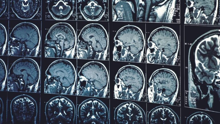 Photo shows multiple MRI brain scans