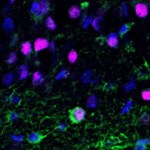Newborn neuron (green and purple cell) in brain tissue from patients with epilepsy (Image by Aswathy Ammothumkandy/Bonaguidi Lab/USC Stem Cell)