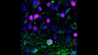 Newborn neuron (green and purple cell) in brain tissue from patients with epilepsy (Image by Aswathy Ammothumkandy/Bonaguidi Lab/USC Stem Cell)