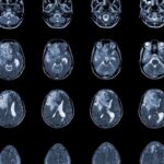 Photo shots MRI brain imaging of glioblastoma