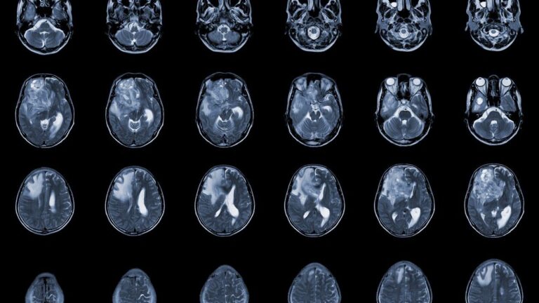 Photo shots MRI brain imaging of glioblastoma