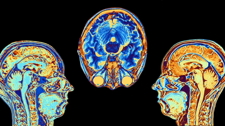 Three different angles of fMRI brain scans