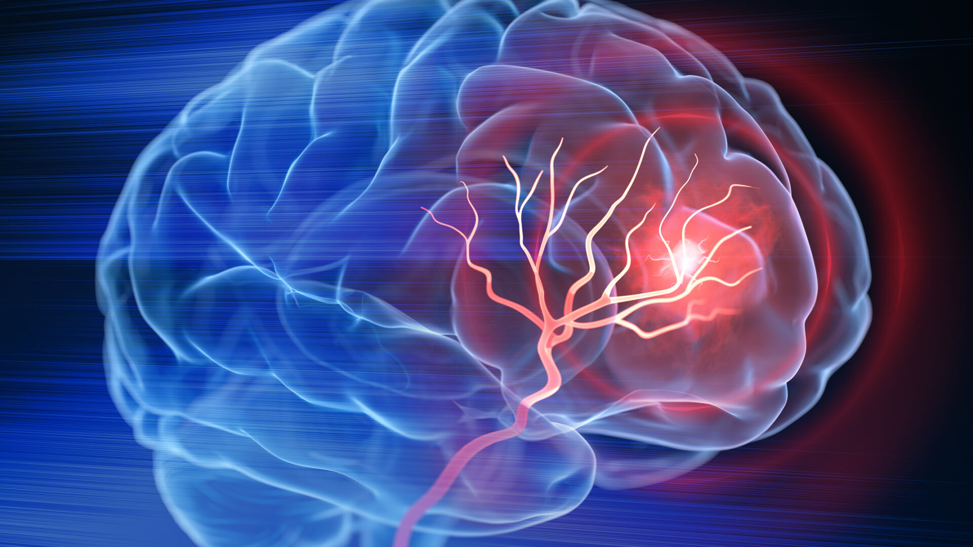 Stem cell transplant for stroke leads to brain cell growth and functional recovery in mice