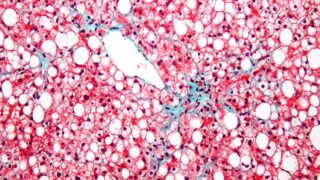 Non alcoholic fatty liver disease