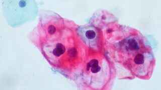 A group of HPV-infected koilocytes on the the bottom right is accompanied by two normal intermediate squamous cells at the top and left.