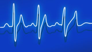 EKG signal