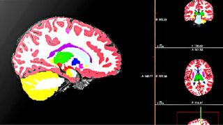 Brain image lit up by sugar