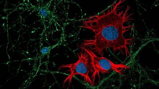 Tumor cells