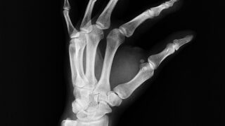 Xray of a hand. Pixabay