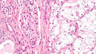 More details High magnification micrograph of a clear cell renal cell carcinoma. H&E stain. Features: Cells with clear cytoplasm, typically arranged in nests. Nuclear atypia is common. The case seen in the image has Fuhrman grade 2/4; the nuclear atypia is moderate and nucleoli could not be seen at 100 X. Related images High mag. (cropped) High mag. Intermed. mag.
