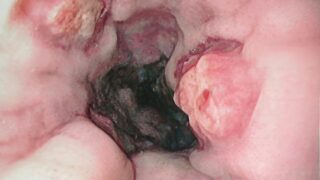 Esophageal varices