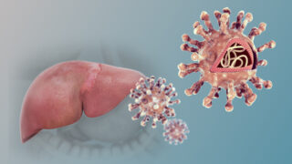 Hepatitis C