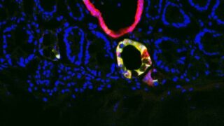 Tumor fluorescence