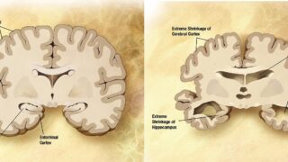 Alzheimer's brain compared to normal brain