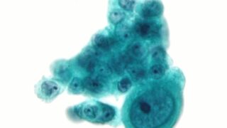 A pair of micrographs of a cytopathology specimen showing a 3-dimensional cluster of cancerous cells (serous carcinoma)