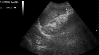 Ultrasound image of spleen
