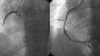 Coronary angiography and angioplasty in acute myocardial infarction (left: Right Coronary Artery [RCA] closed, right: successfully dilated)