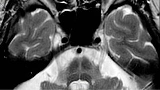 Hot Cross Bun sign that is commonly found in MRI of multiple system atrophy