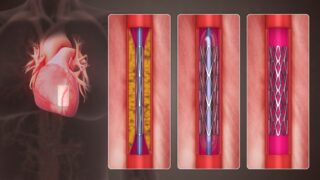 3D Medical Animation still shot of procedure of Percutaneous coronary intervention (formerly known as angioplasty with stent)