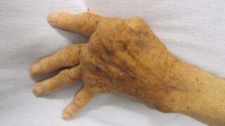 Hand with arthritis