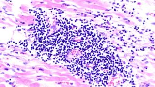Histologic slide demonstrating viral myocarditis, an infection of the heart muscle