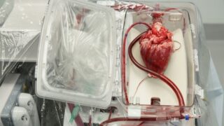 Heart awaiting transplantation