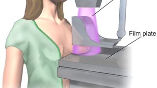 Schematic image showing a woman undergoing a mammogram imaging examination.