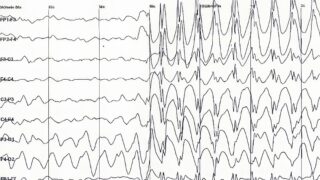 Epilepsy spike waves
