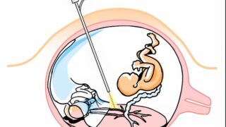 Schematic illustration of endoscopic fetal surgery for twin-to-twin transfusion syndrome
