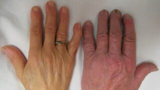 The pale hand of a woman with severe anemia (left) in comparison to the normal hand of her husband (right)