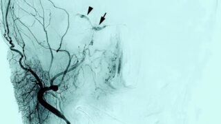 Cerebral angiogram of a carotid-cavernous fistula