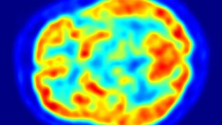 PET image of the human brain