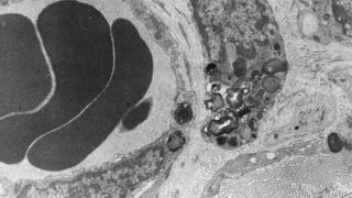 Transmission electron micrograph of a microvessel displaying pericytes lining the outer surface of endothelial cells that are encircling an erythrocyte (E).