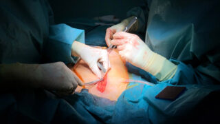 Laparotomy the process of peritoneal incision. Operating room undergoing surgery. Health care and medical concept