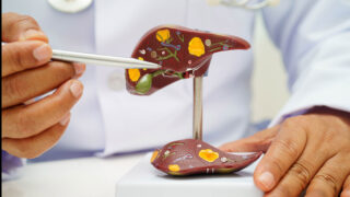 Cirrhosis, Liver cancer, fatty liver, Asian doctor with liver human anatomy model in World Hepatitis Day at hospital.