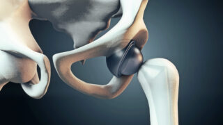 Xray of Hip Replacement,Medicine, medical and healthcare, surgery, science concepts.